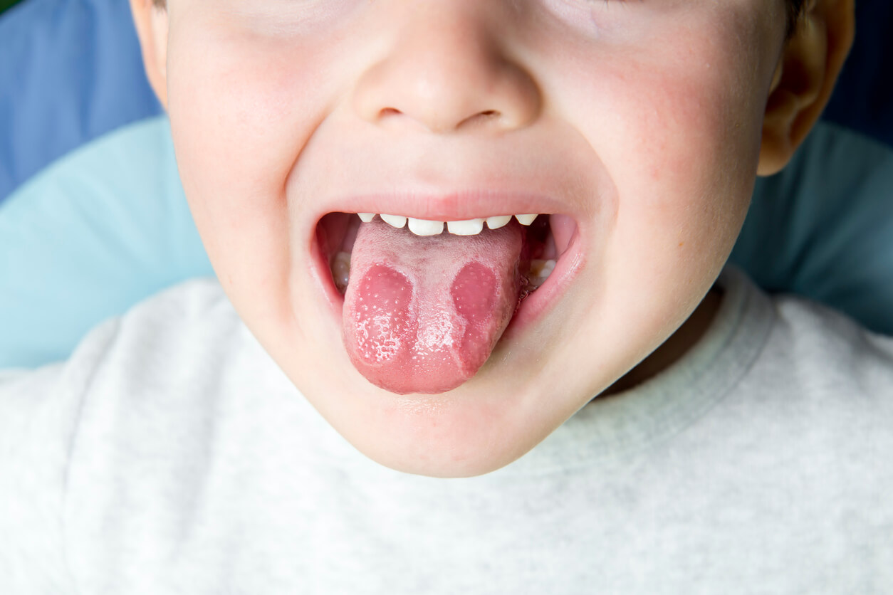 Un enfant avec des mycoses sur la langue.