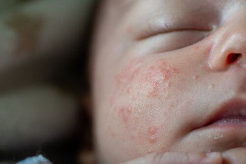 Las manchitas rojas en la piel del bebé incluyen el acné neonatal