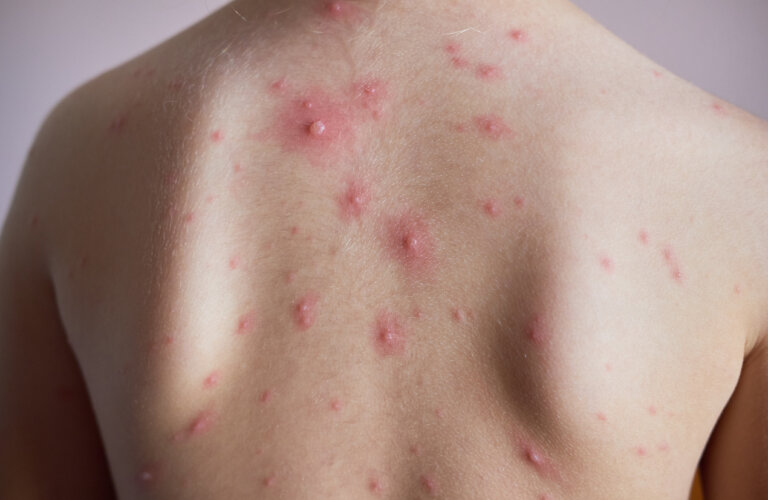 Cómo prevenir y tratar las marcas de varicela