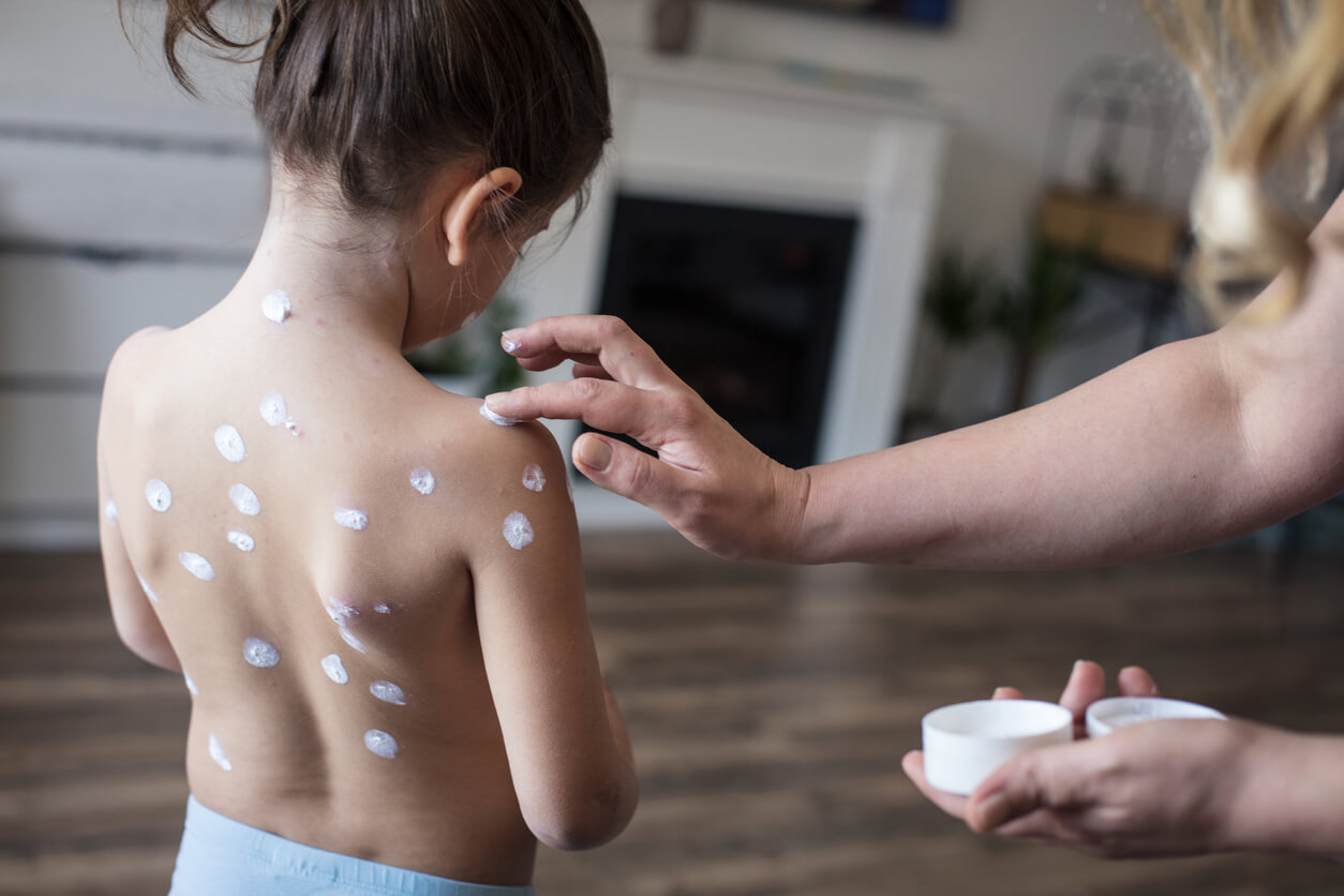 A mother applying cream to her little girl's chickenpox marks.