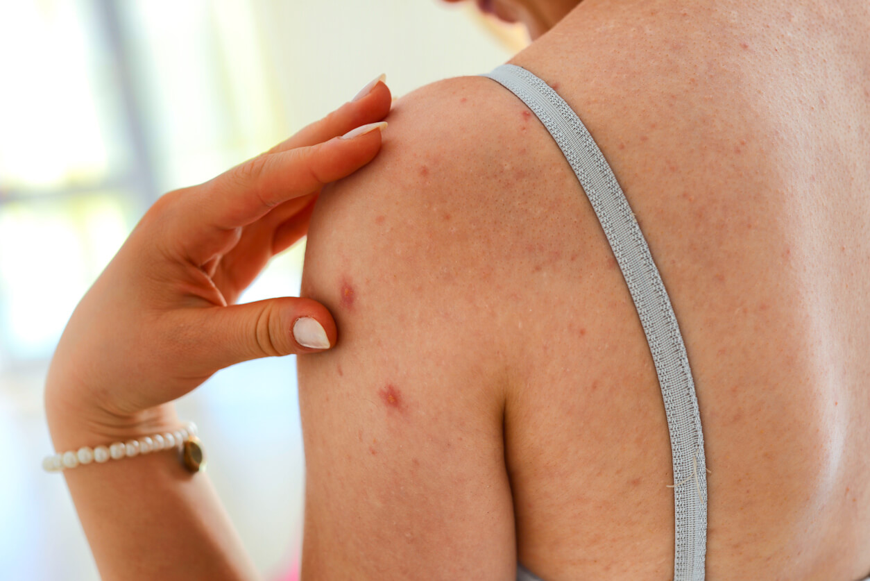 A woman with chickenpox scars on her shoulder.