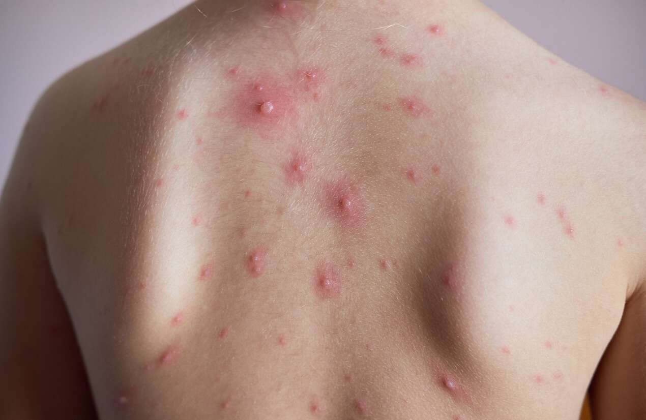Las manchitas rojas en la piel del bebé pueden ser por varicela