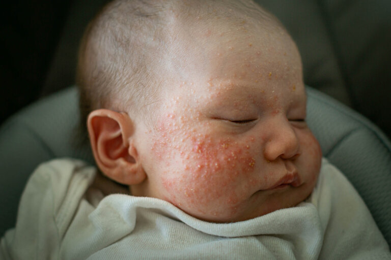 10 signos de alarma en la piel de los recién nacidos