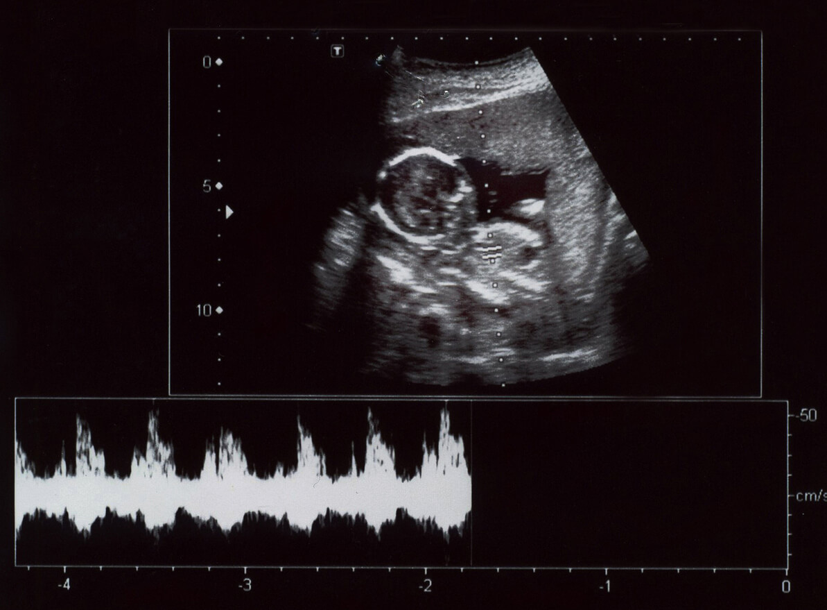 Ultraäänitutkimuksen avulla voidaan tutkia vauvaa.