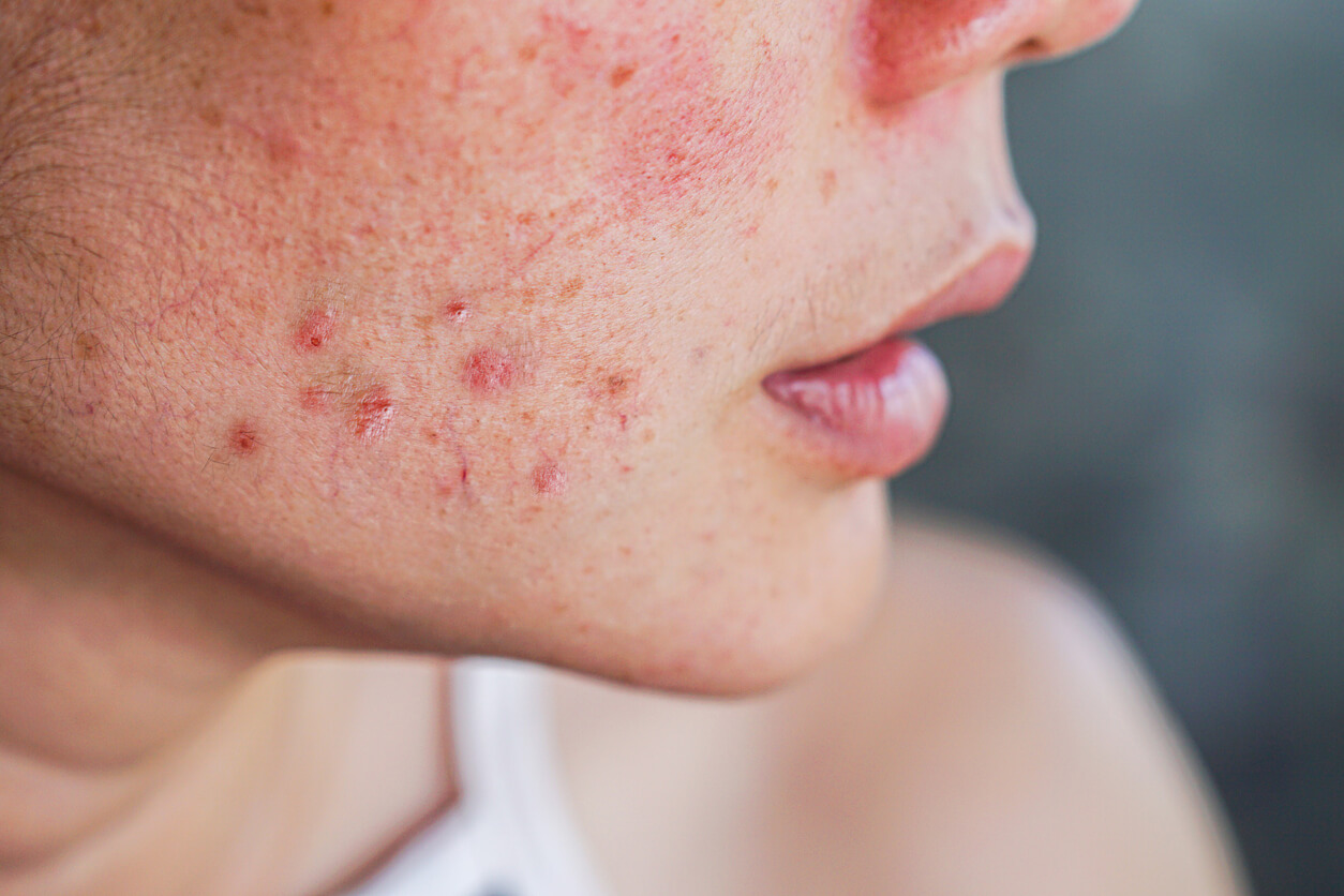 The profile of a person with acne.