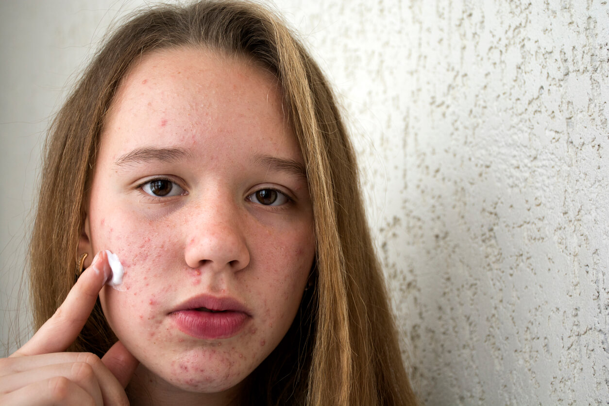 En tenåringsjente med akne som smører krem i ansiktet.