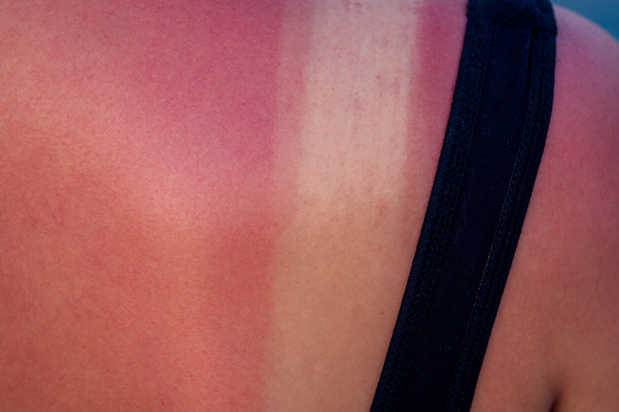 Quemaduras solares durante el embarazo: riesgos y tratamiento