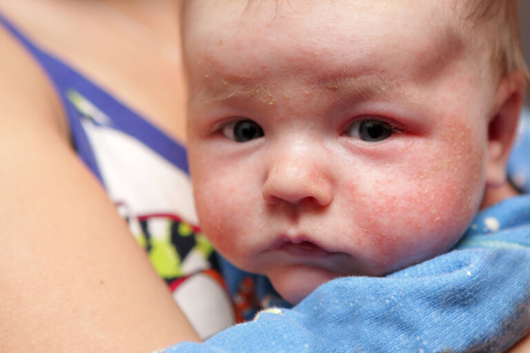 Petequias en el bebé: síntomas, causas y tratamiento