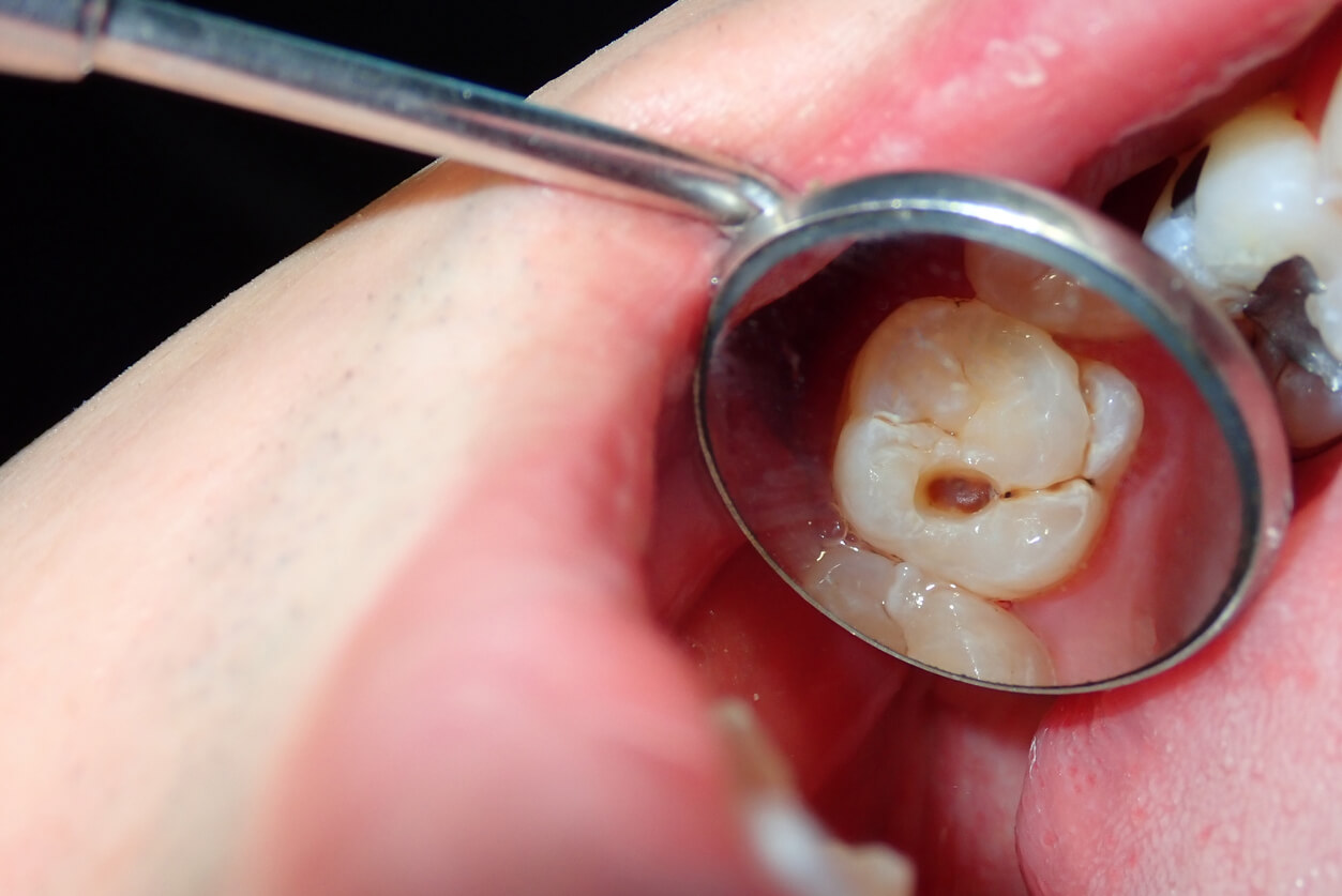 A cavity in a tooth.