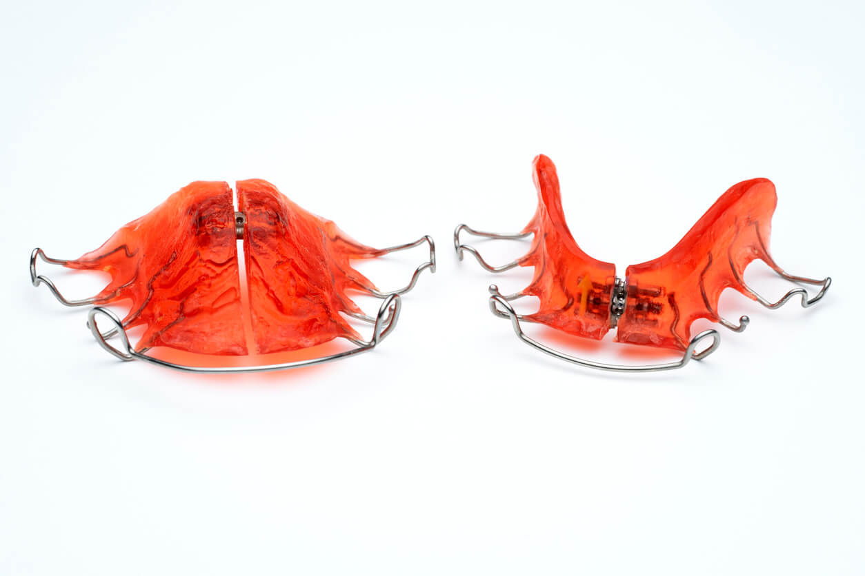 Permanent Expander What Is a Palate Expander and When Is It Used?
