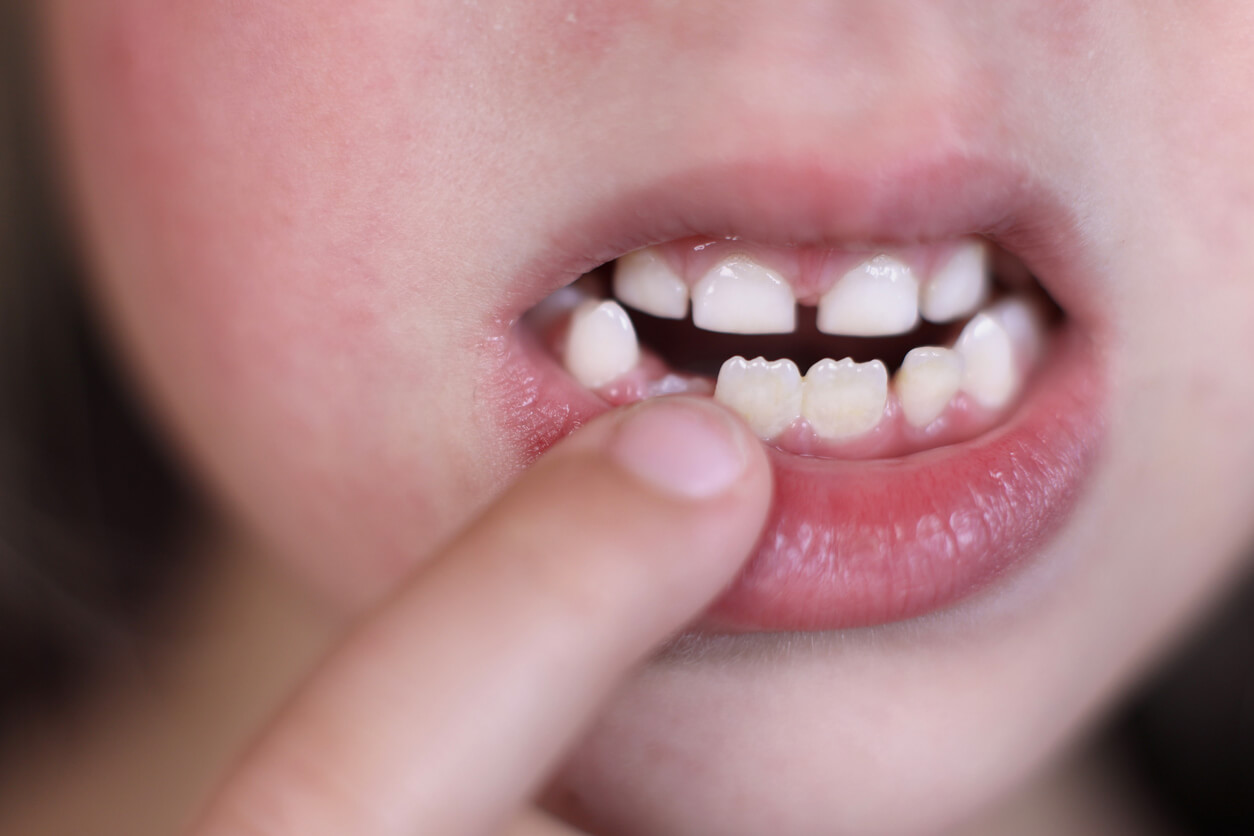 Dientes en forma de sierra: ¿es normal? - Eres Mamá