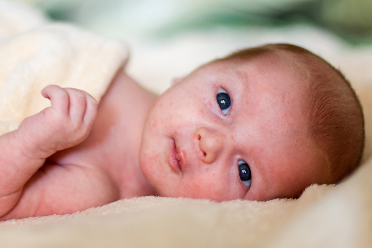 Un bébé avec des taches rouges sur le visage.
