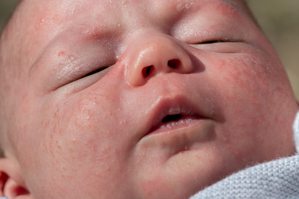 Visage d'un bébé à la peau sensible.