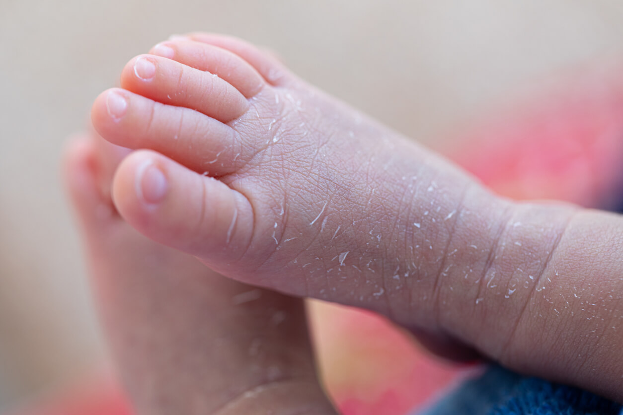 A baby's foot with flaky skin.