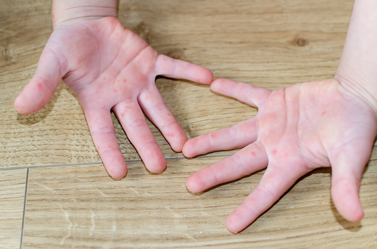Deux mains d'enfant atteintes de dermatite.