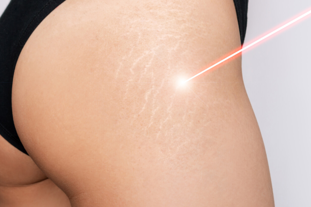 Laserhoito tehoaa raskausarpiin.