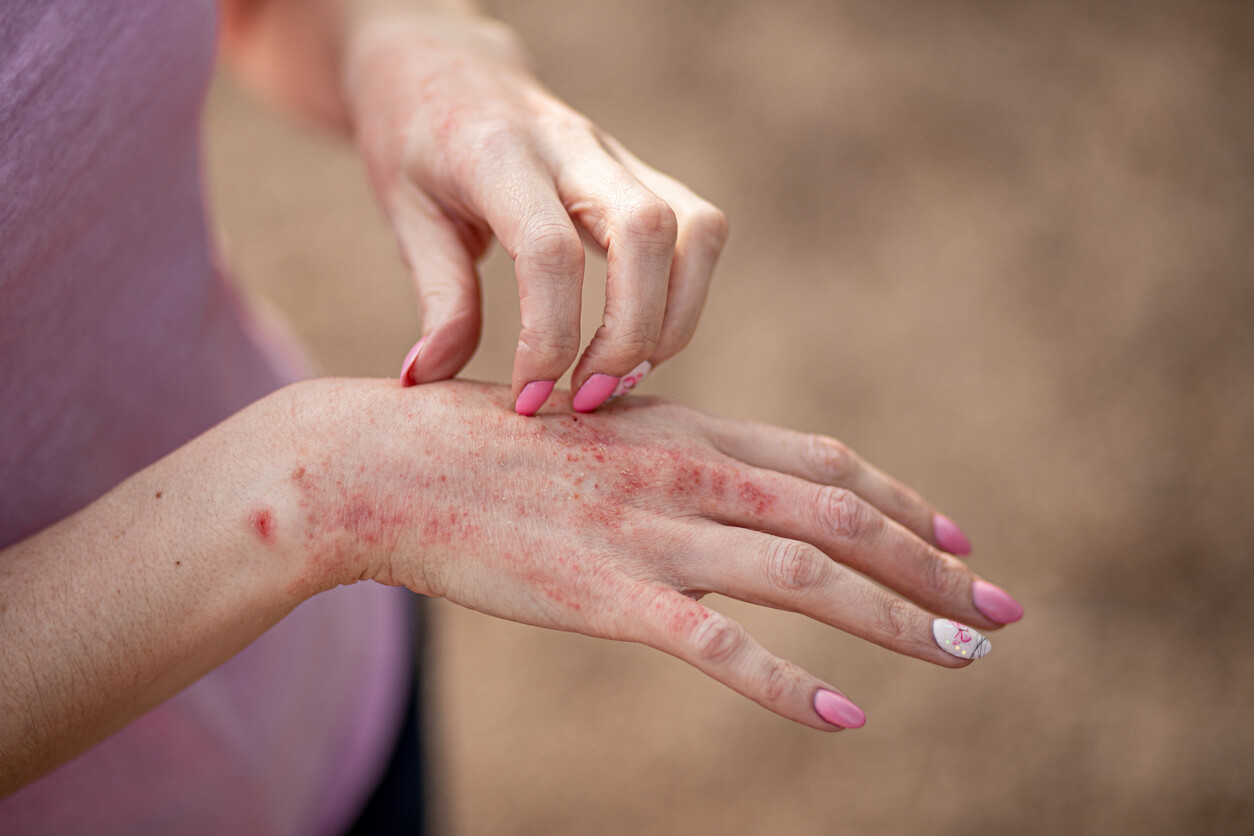 A woman with an itchy rash on her hand.