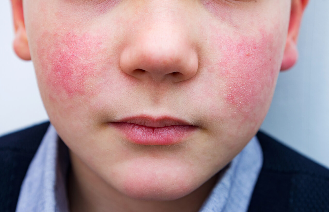 A child with a rash on his cheeks.