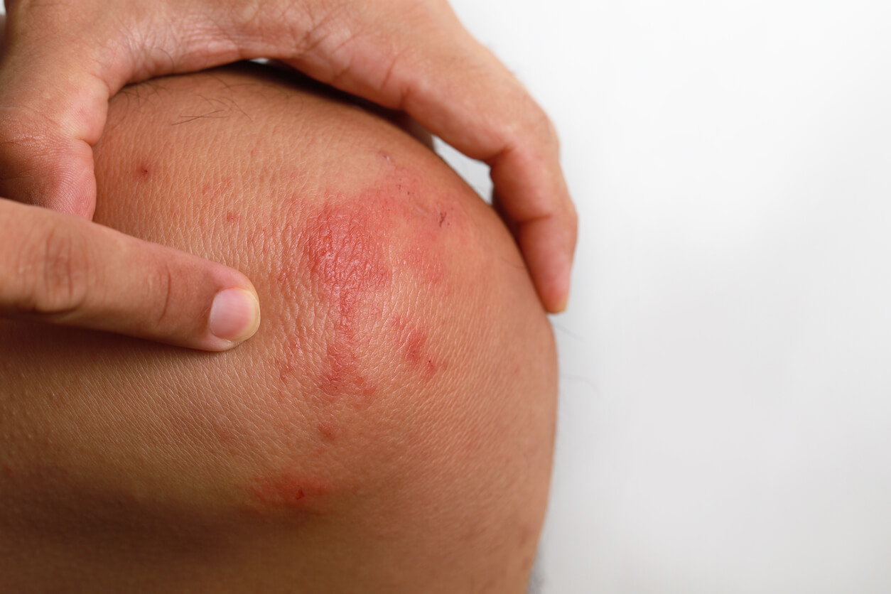 A person with a rash on their knee.