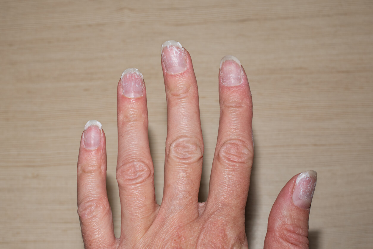 A woman with with dry, flaky nails.