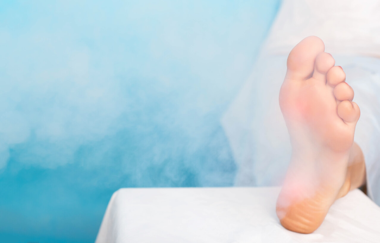 Cryotherapy for wart removal.