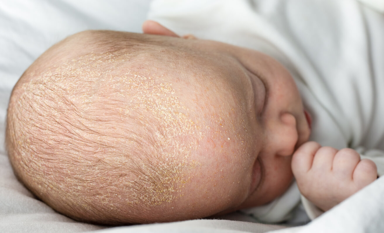 A newborn with cradle cap sleeping.