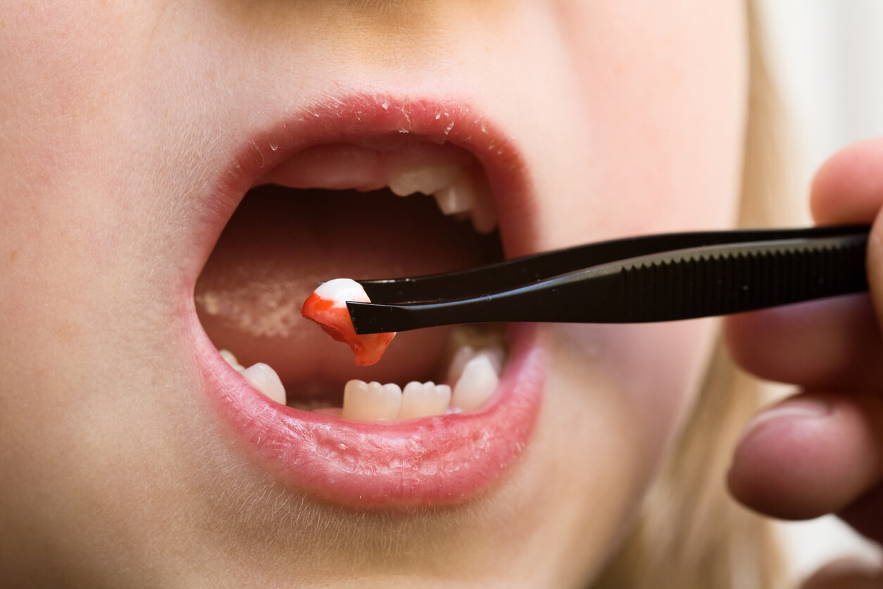Eksempel på tandudtrækninger hos børn