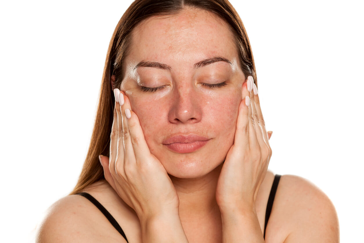 A woman with melasma touching her face.