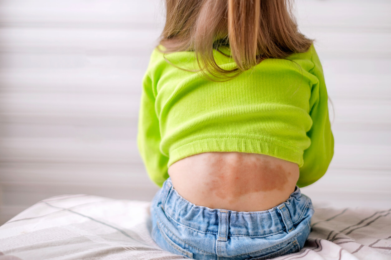 A child with a large dark spot on her lower back.