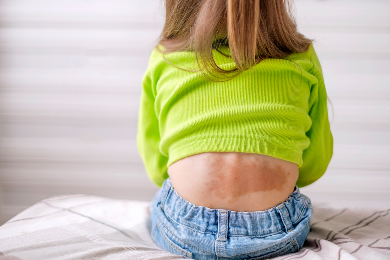 Eksempel på pityriasis versicolor hos babyer og børn