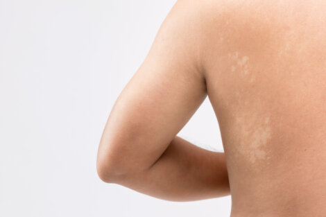 Pitiriasis versicolor en bebés y niños: causas, síntomas, tratamiento