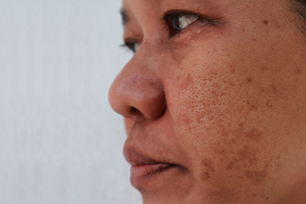 Cloasma gravídico: lo que debes saber