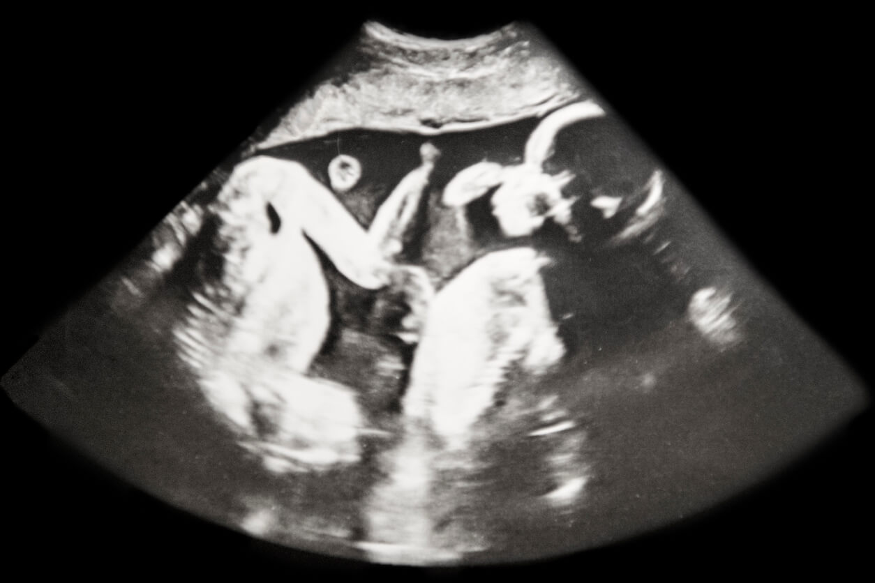 An ultrasound image of twins.
