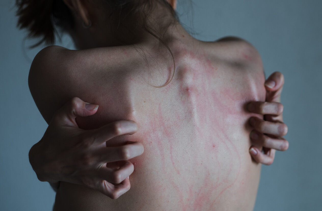 A teenager scratches her back in order to injure herself.