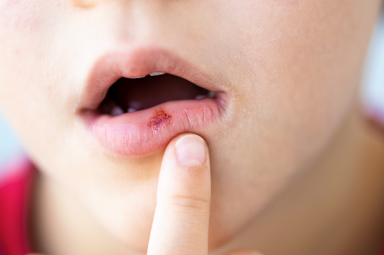 A young child with a cold sore.