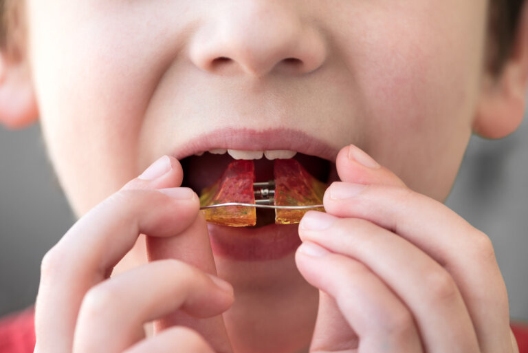 Ortodoncia infantil: ¿A qué edad se puede iniciar?