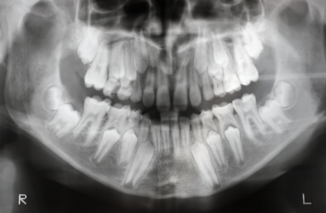 A dental X-ray of a child's mouth.