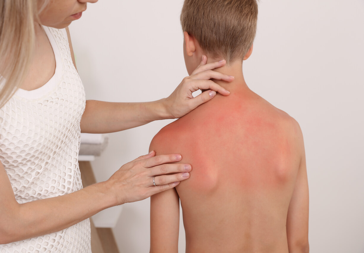 Quemaduras solares en bebés y niños: qué debes saber