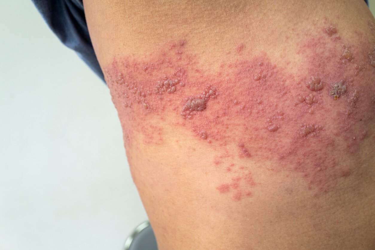 Herpes-zoster op de rug van een persoon