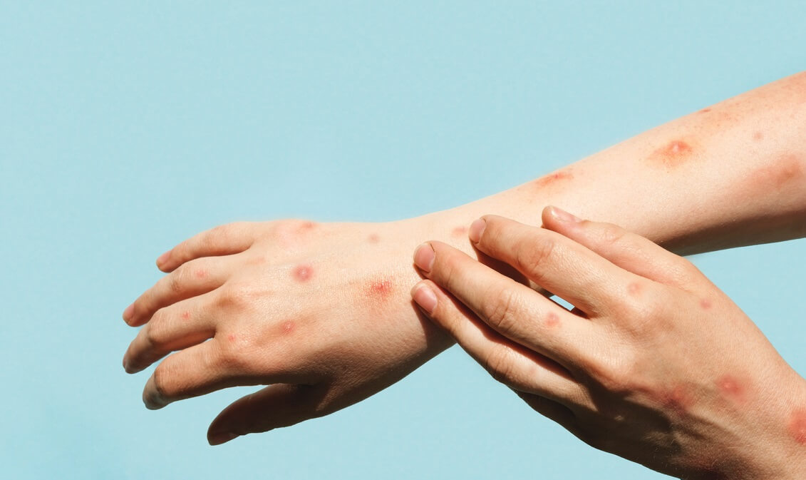 Apinarokko aiheuttaa ihottumaa.