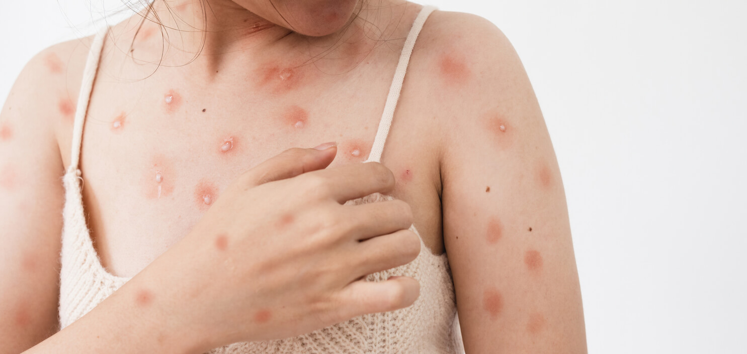 A woman with itchy blisters on her chest and shoulders.