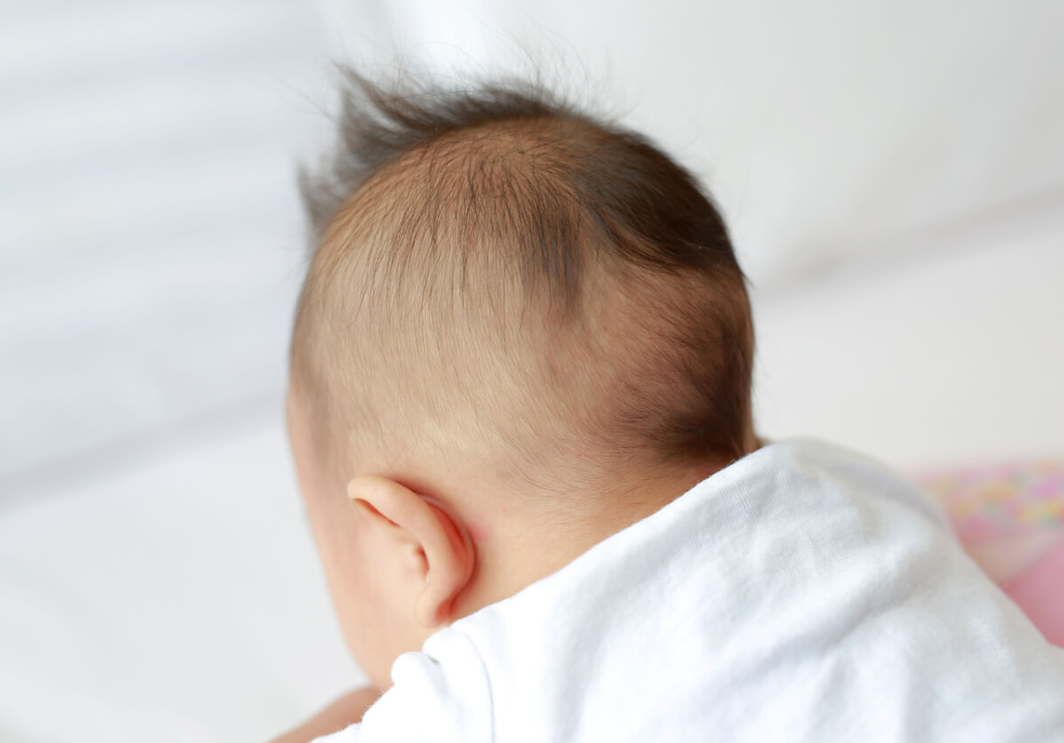 Alopecia en bebés: causas y cuidados
