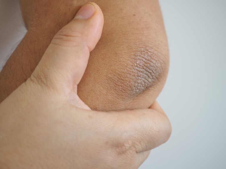 ¿Es posible aclarar los codos y rodillas oscuras en los niños?