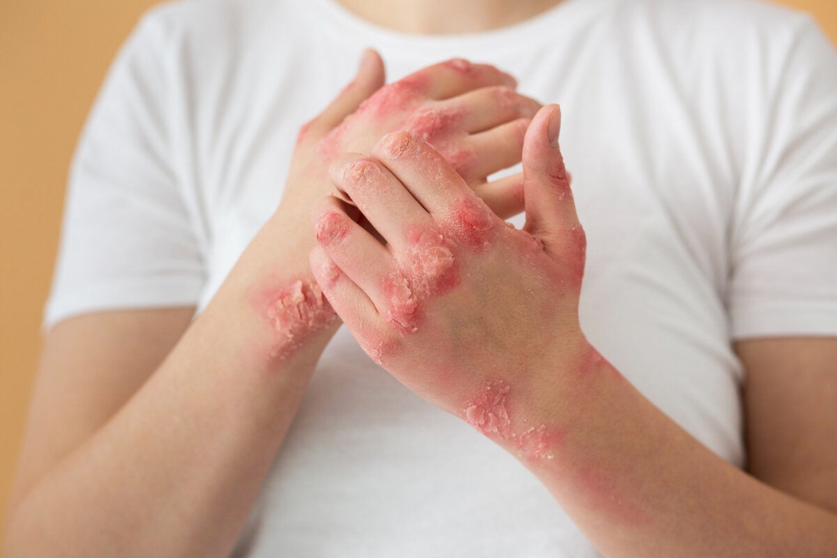 10 afecciones de la piel por enfermedades autoinmunes