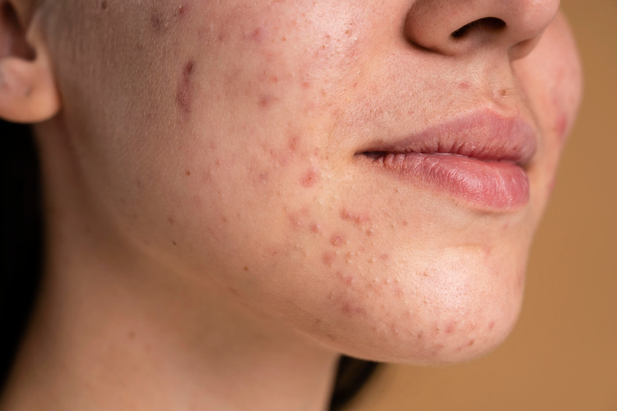 ¿Qué causa el acné de la mujer adulta? Aprende cómo tratarlo