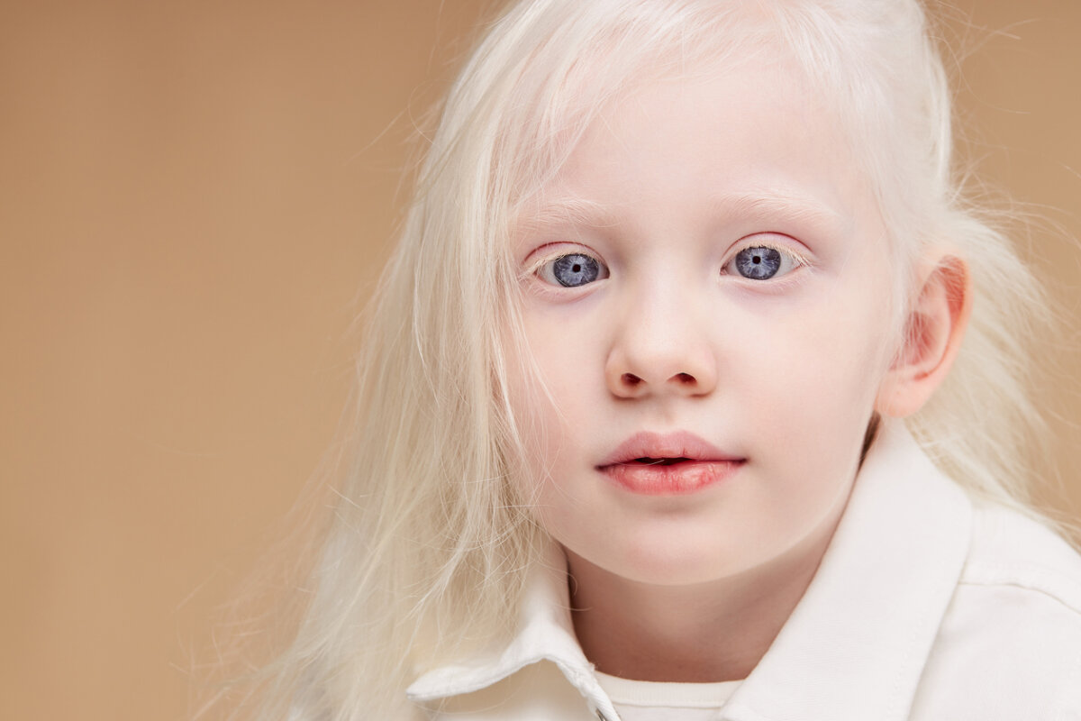 ¿Cómo cuidar la piel de un niño albino?