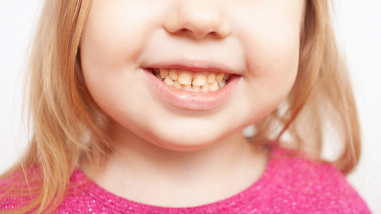 Mi niño tiene los dientes amarillos: posibles causas y qué hacer