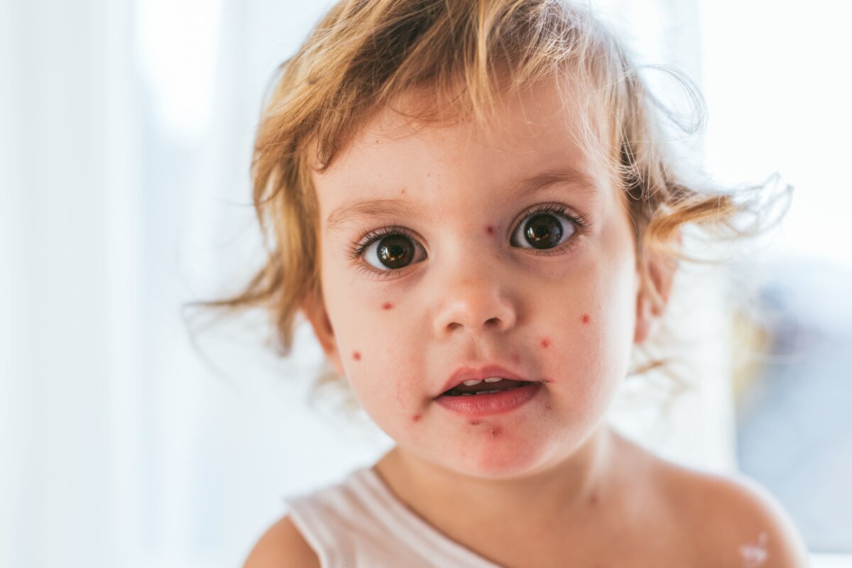 El acné en los niños pequeños: por qué ocurre y qué hacer