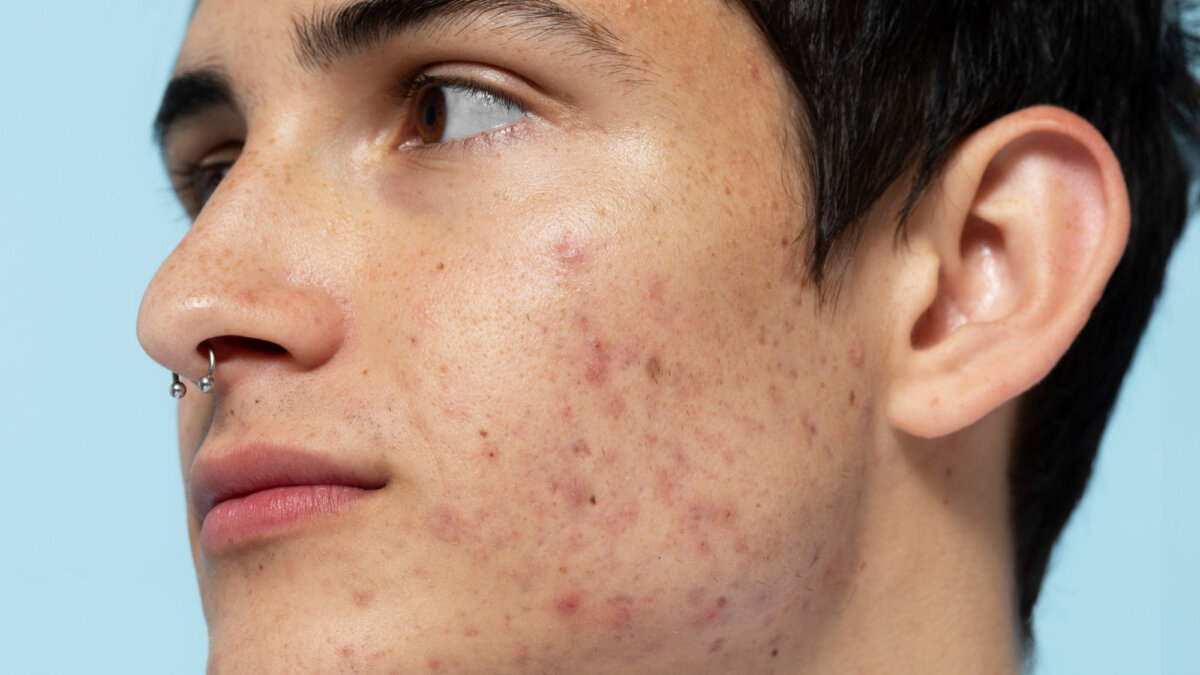 6 probióticos para el acné en adolescentes
