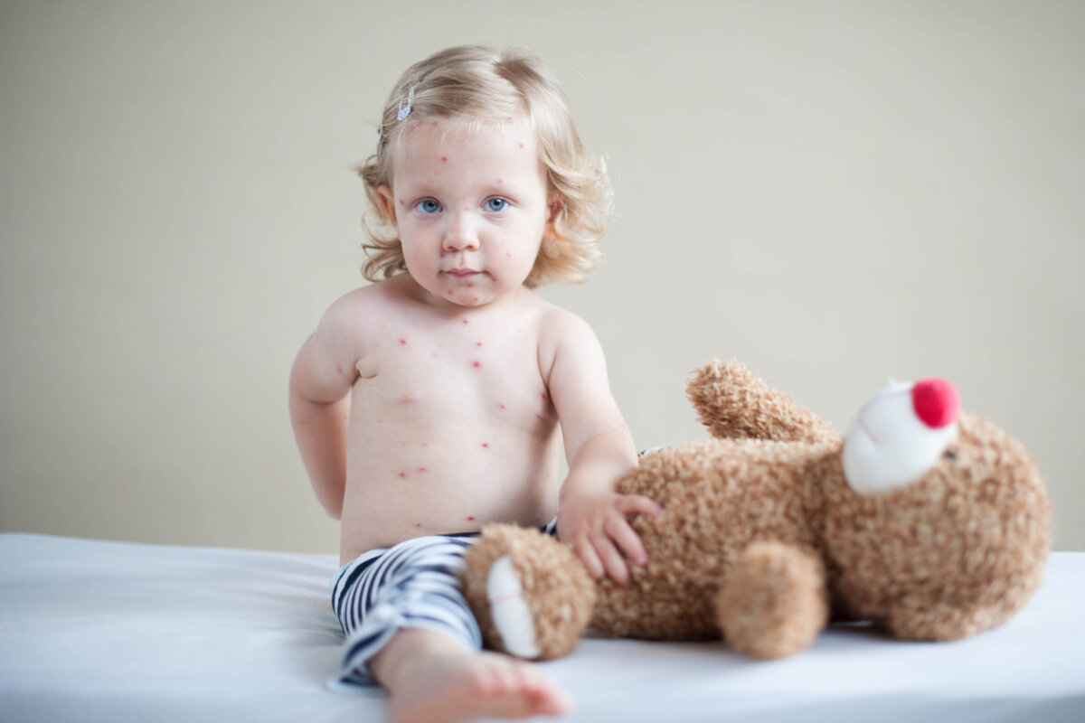 Los 10 tipos de sarpullidos en bebés que debes conocer